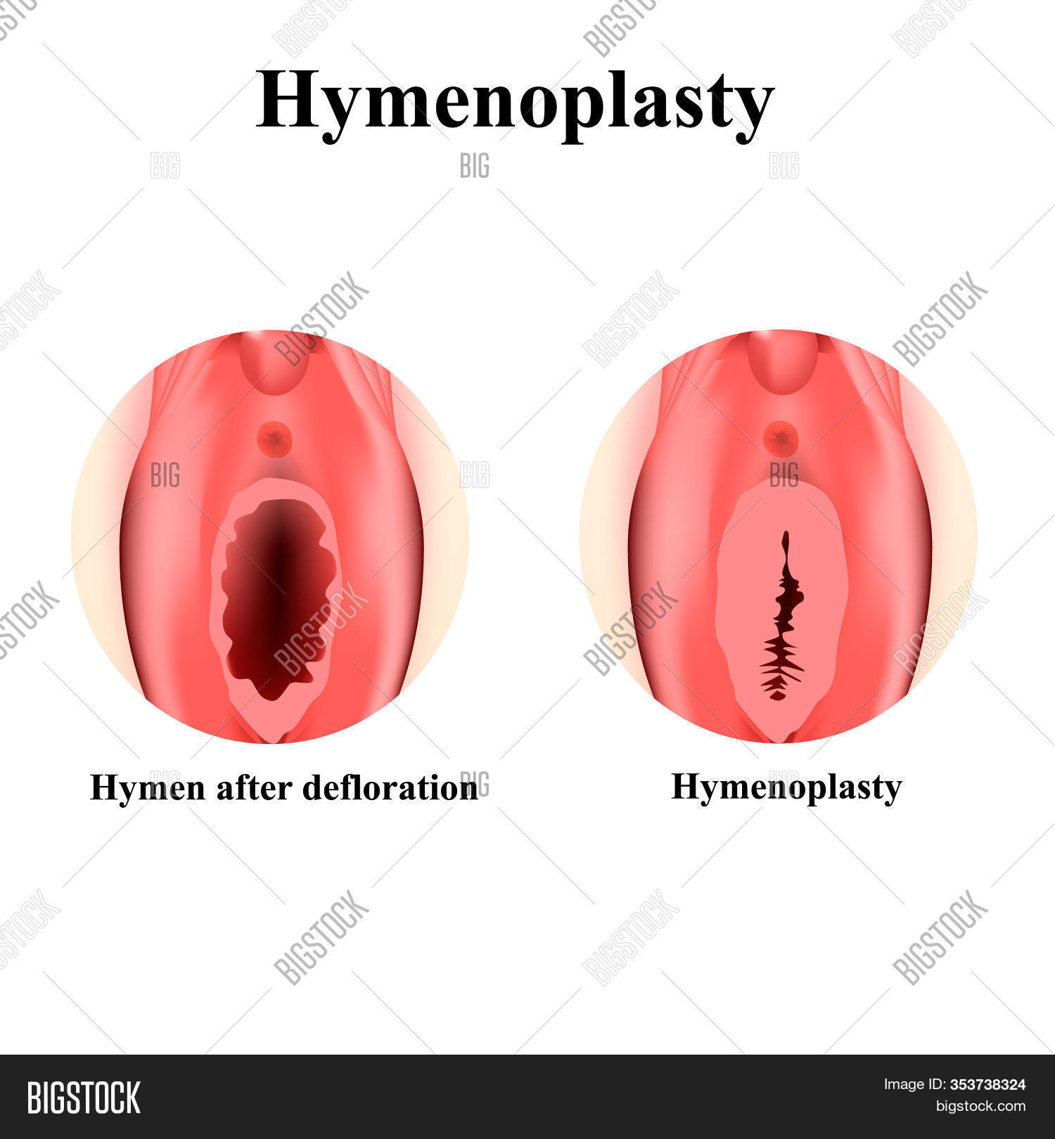hymen 