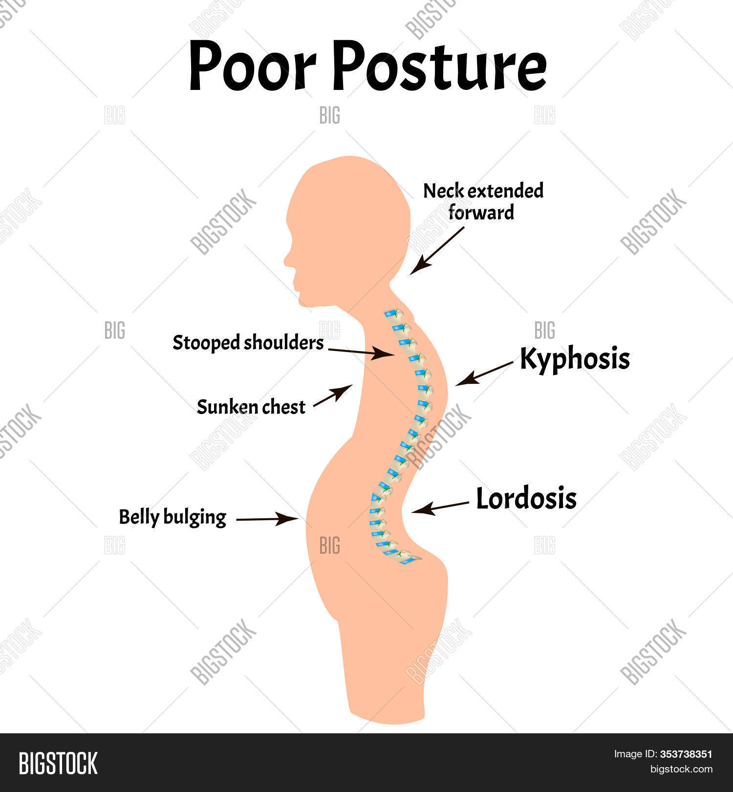 Improper Posture Image Photo Free Trial Bigstock