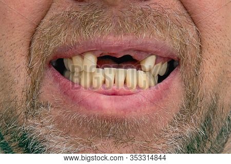 Smile Of A Bearded Man Without Upper Front Teeth, Gum Disease In Humans, Paradontosis, Close-up