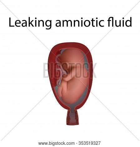 Leaking Amniotic Fluid Image & Photo (Free Trial) | Bigstock