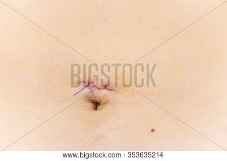 Body Scars After Appendicitis Removal. Small And Neat Scars After Laparoscopy Surgery. Young Bodey.