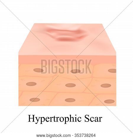 Scars Hypertrophic. The Anatomical Structure Of The Skin Scar. Illustration On Isolated Background.