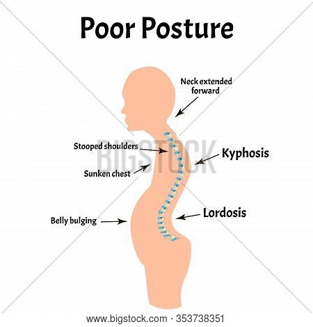 Improper Posture Symptoms. Text Neck Syndrome. Spinal Curvature, Kyphosis, Lordosis, Scoliosis, Arth
