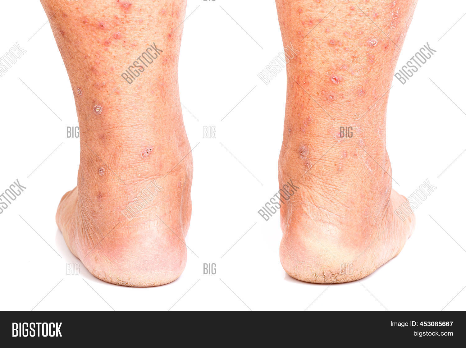 Itchy Skin Lesions Image & Photo (Free Trial) Bigstock