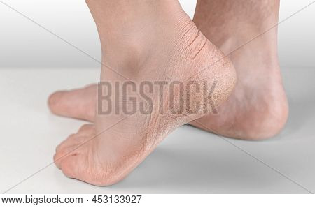 Dry And Cracked Soles Of Feet On Gray Background, Foot With Dry Heels, Cracked Skin Heel Of Foot Wit