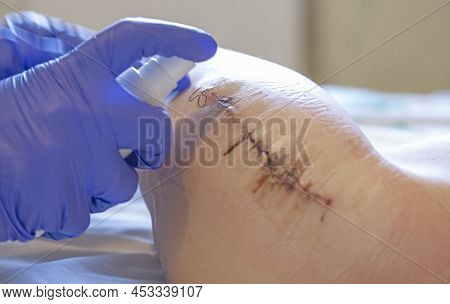 Postoperative Dressing, The Hands Of A Doctor In Blue Gloves, A Nurse Or A Doctor Who Treats The Pat