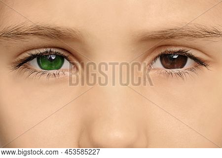 Little Girl With Different Colors Of Eyes, Closeup. Heterochromia Iridis