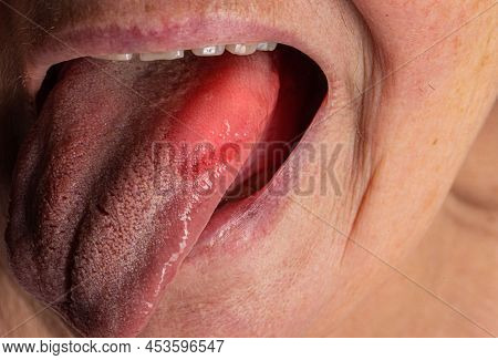 Inflammatory Disease In The Tongue. Red Spot, Glossitis. Hygiene Of The Tongue