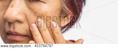 Menopausal Women Worry About Melasma On Face.