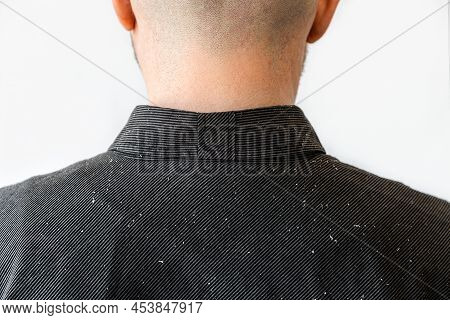 Close Up View Of Man's Shoulders In Black Shirt Covered With Dandruff. Back View. Copy Space. The Co