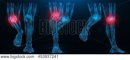 Polygonal Vector Illustration Of Human Legs, Inflammatory Disease Of The Knee Joint Concept. Low Pol