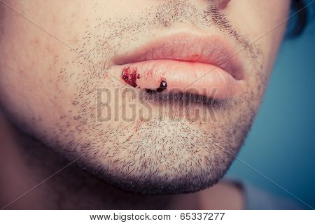 Man With Cold Sore And Blood On Lip