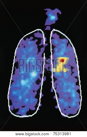 Graphic Image Showing Disease In Human Lung