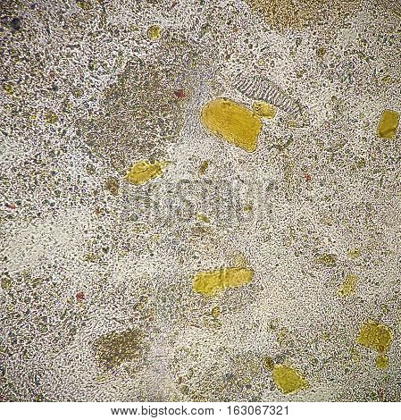 Undigested muscle fibers in human stool sample under microscope