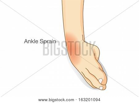 Ankle sprain and swelled. This illustration about common foot injuries.