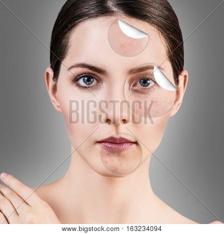 Circles layers of skin with acne unstick from good healthy skin of young woman.