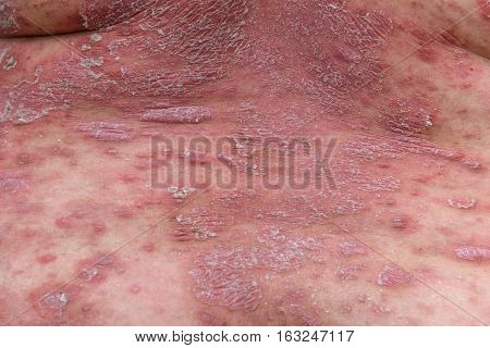 Psoriasis is an autoimmune disease that affects the skin cause skin inflammation red and scaly.