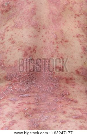 Psoriasis is an autoimmune disease that affects the skin cause skin inflammation red and scaly.