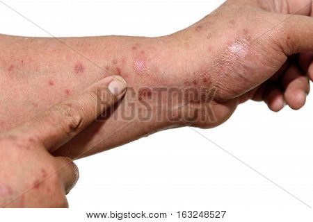 Psoriasis is an autoimmune disease that affects the skin cause skin inflammation red and scaly.