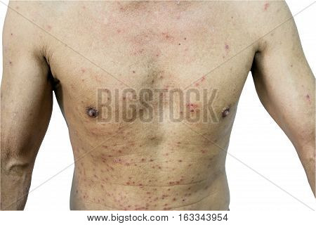 Close up A man and papule rash in body on white background.Saved with clipping path.