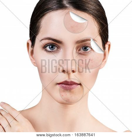 Circles layers of skin with acne unstick from good healthy skin of young woman.