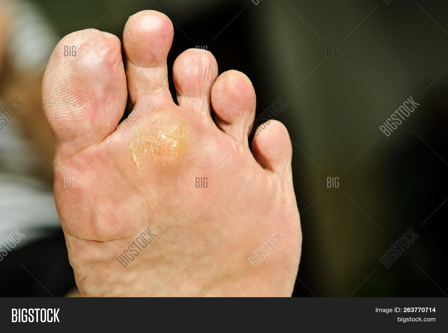 Wart Under Foot Can Image & Photo (Free Trial) Bigstock