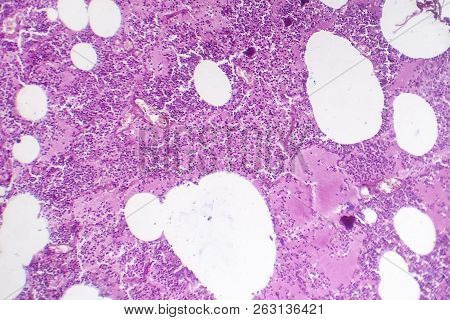 Lobar Pneumonia, Hemorrhagic Edema Period, Light Micrograph, Photo Under Microscope