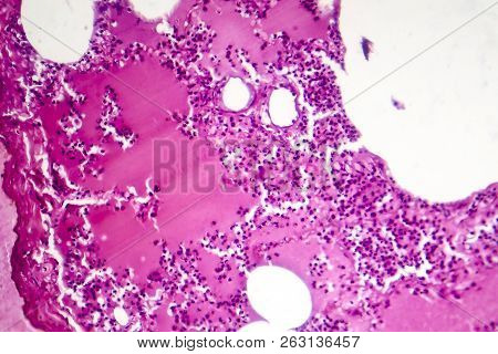 Lobar Pneumonia, Hemorrhagic Edema Period, Light Micrograph, Photo Under Microscope