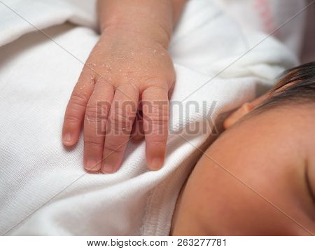 Closeup Hand Of A Newborn With A Skin Peeling On White Cloth. Skin Allergies In Newborn Called Verni