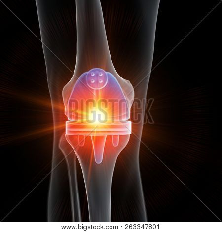 3d rendered medically accurate illustration of a knee replacement