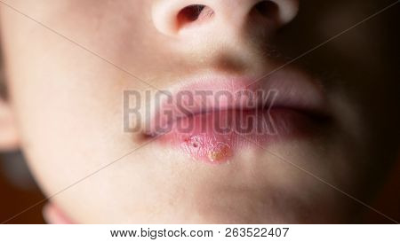 Herpes On The Lips Of A Boy. Herpes. Lip Treatment, Copy Space