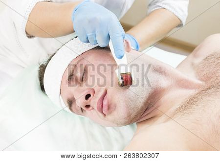 The Man Undergoes The Procedure Of Medical Micro Needle Therapy With A Modern Medical Instrument Der
