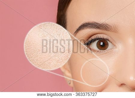 Young Woman With Dry Skin On Pink Background, Closeup