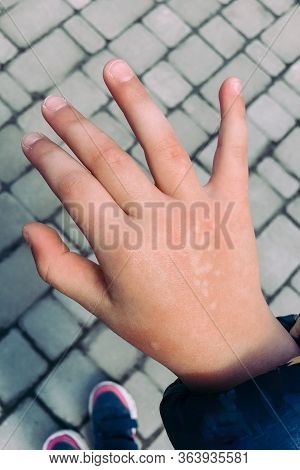 The Girl Burned Her Hand With Nettle Grass. Type Of Burn.