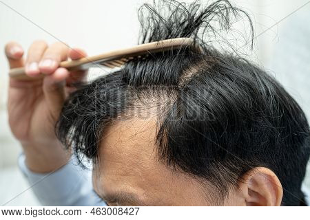 Bald In The Middle Head And Begin No Loss Hair Glabrous Of Mature Asian Business Smart Active Office