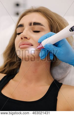 Macro Close Up Detail Of Laser Plasma Pen Removing Facial Wart On Young Woman. Noninvasive Cosmetic 