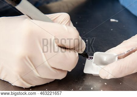 Scientist Preparing Paraffin Blocks Containing Biopsy Tissue For Sectioning. Pathology Laboratory. C