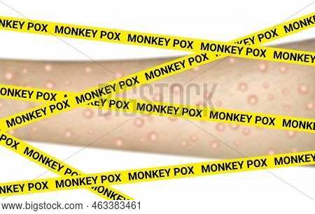 Monkey Pox Yellow Crime Spot Line On Blur Pox Virus In Human Body.