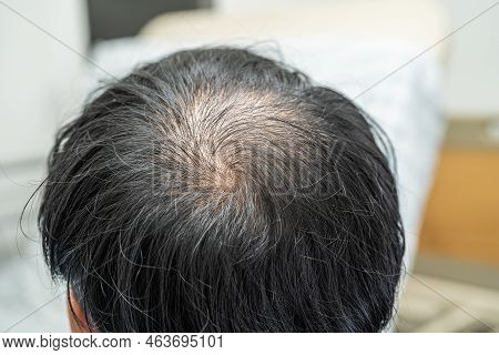 Bald In The Middle Head And Begin No Loss Hair Glabrous Of Mature Asian Business Smart Active Office