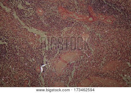 Cells of a human ovary with Ovarian cancer cells under the microscope.