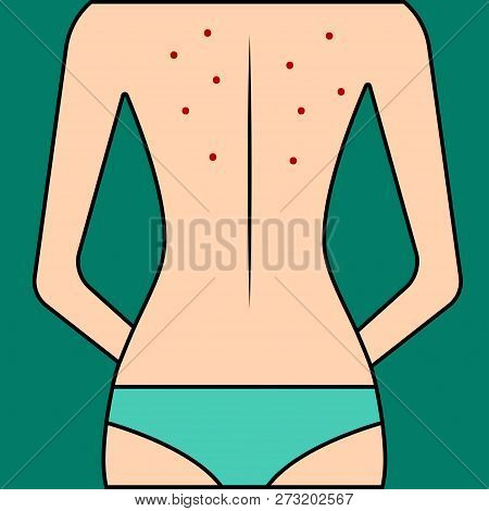 Acne On Female Back, Hormonal Imbalance, Infectious Skin Disease, Skin Care, Back Skin Treatment. Ve