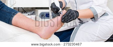Podology Treatment. Podiatrist Treats Foot. Podiatry Doctor Or Dermatologist Treats The Patient In M