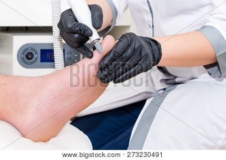 Podology Treatment. Podiatrist Treats Foot. Podiatry Doctor Or Dermatologist Treats The Patient In M