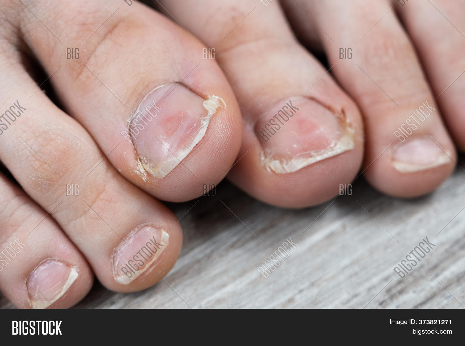 Ugly Toes Girl Fungus Image & Photo (Free Trial) | Bigstock
