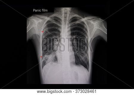 Xray Film Of A Patient With Active Pulmonary Tuberculosis In The Right Lung (red Arrows).