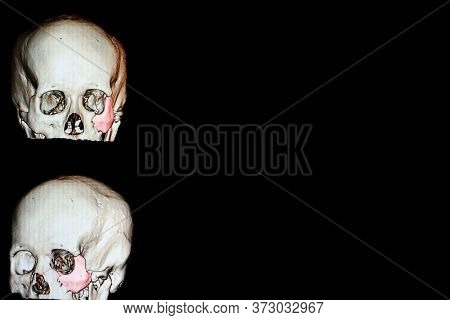 3-d Redering Film Of A Patient Skull With Traumatic Brain Injury Showing Fractured Zygomatic Bone (p
