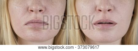 Photos Of Female Lips Before And After Cheiloplasty. Correction Of The Prolapse Of The Corners Of Th