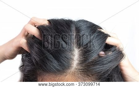 Women Head With Dandruff Caused By The Problem Of Dirty. Or Caused By Skin Disease Or Seborrheic Der