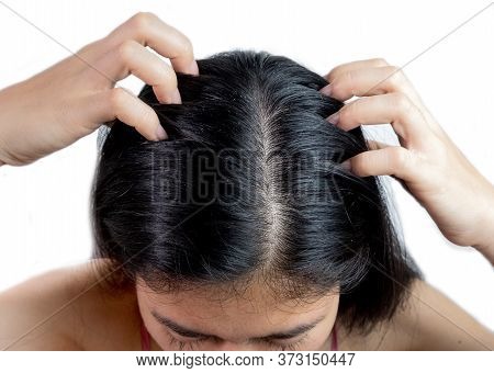 Women Head With Dandruff Caused By The Problem Of Dirty. Or Caused By Skin Disease Or Seborrheic Der