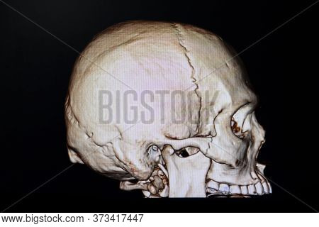 3 D Rendering Of A Skull Of A Patient With Traffic Accident  Showing Fracture Of Right Zygomatic Bon